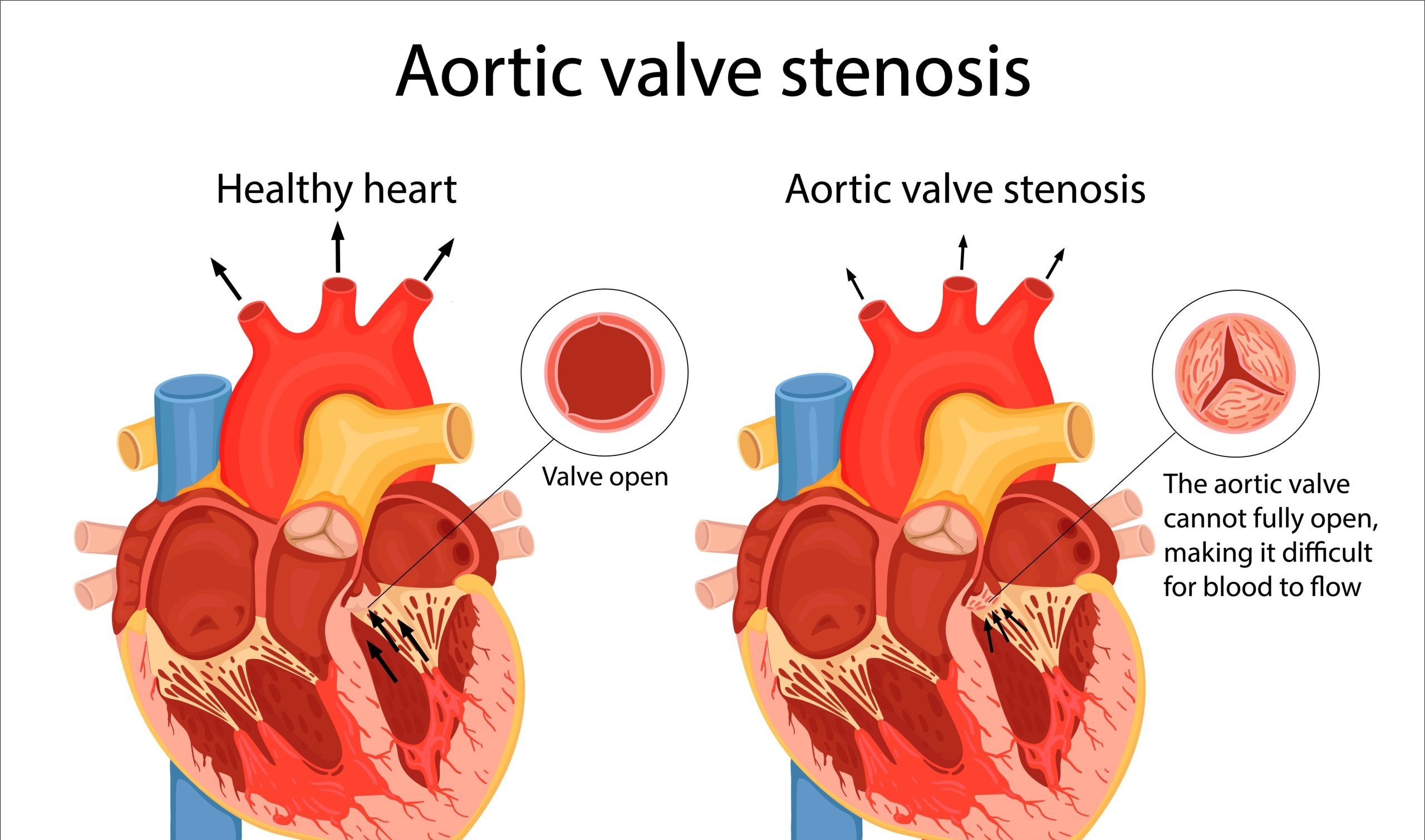 Aortic Stenosis Detection Project